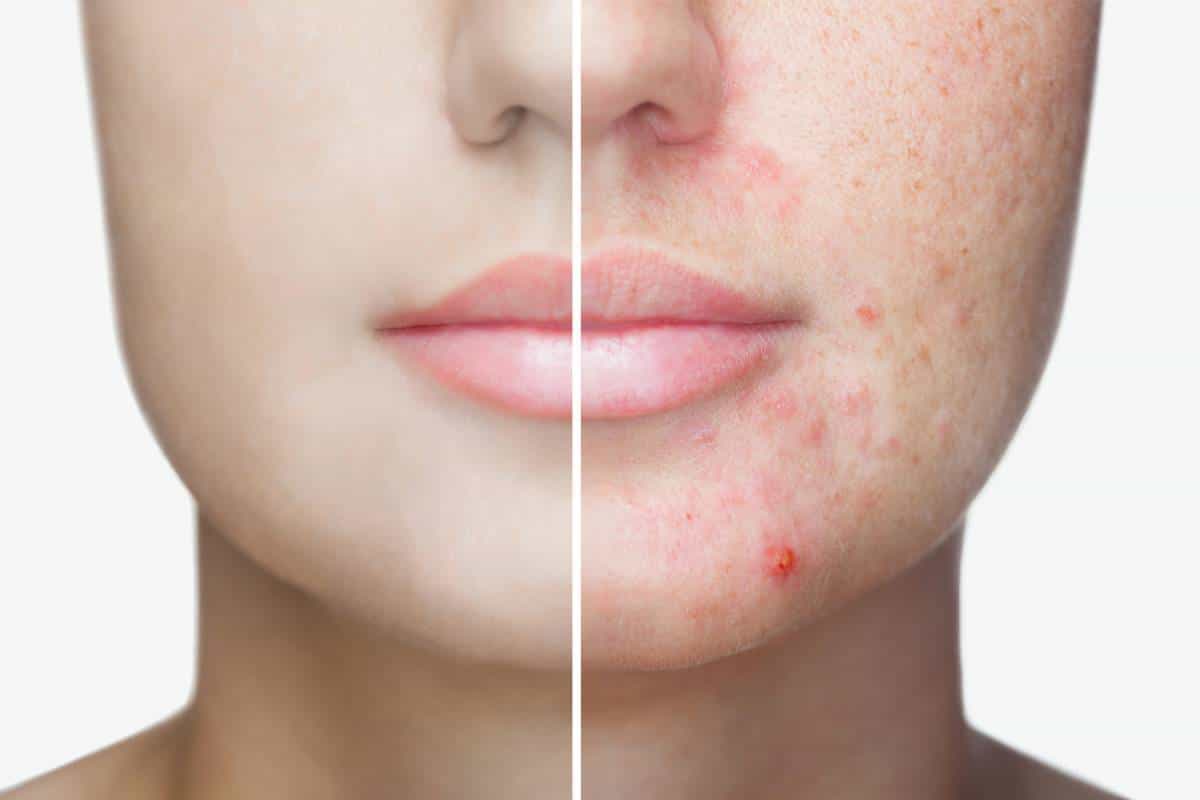 Les cicatrices d'acné ne sont pas une fatalité ! Voici comment s ...