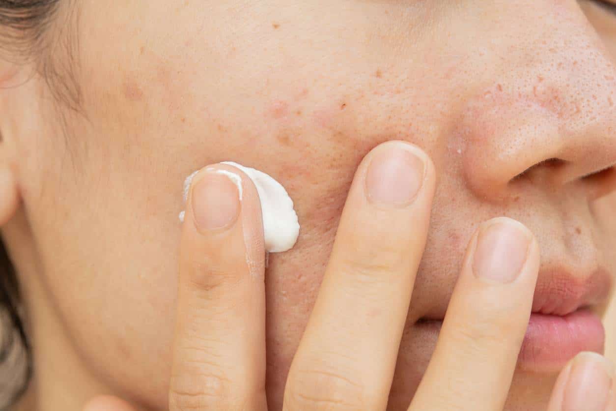 Les cicatrices d'acné ne sont pas une fatalité ! Voici comment s'en débarrasser